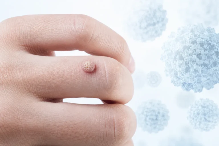 Are All Warts Caused by HPV?