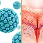 Can Cause Genital Warts and Cervical Cancer?